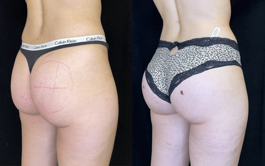 buttock augmentation2