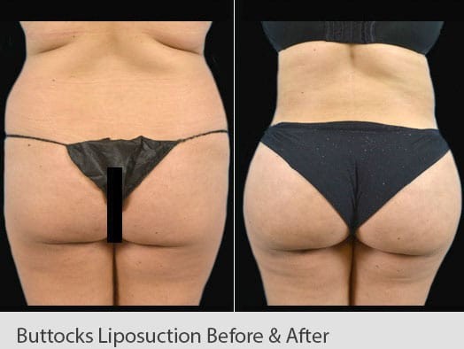 buttocks lipocustion