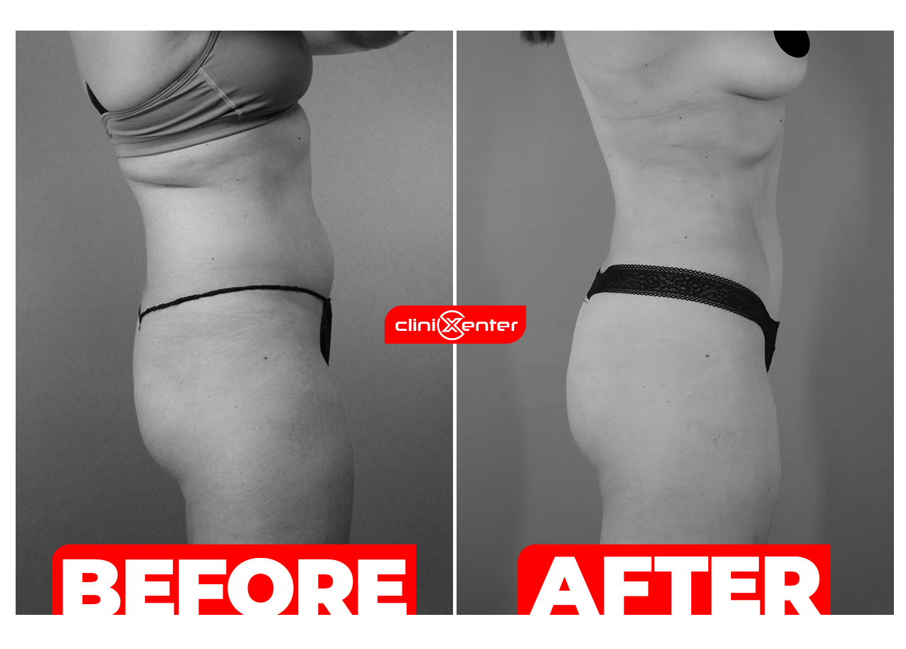 360 Liposuction Before After cover