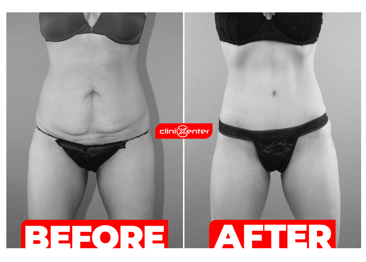 Abdominoplasty Before and After cover