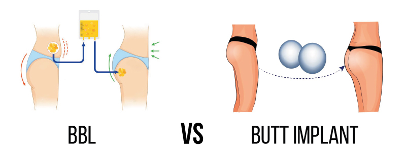 Butt Implants vs BBL