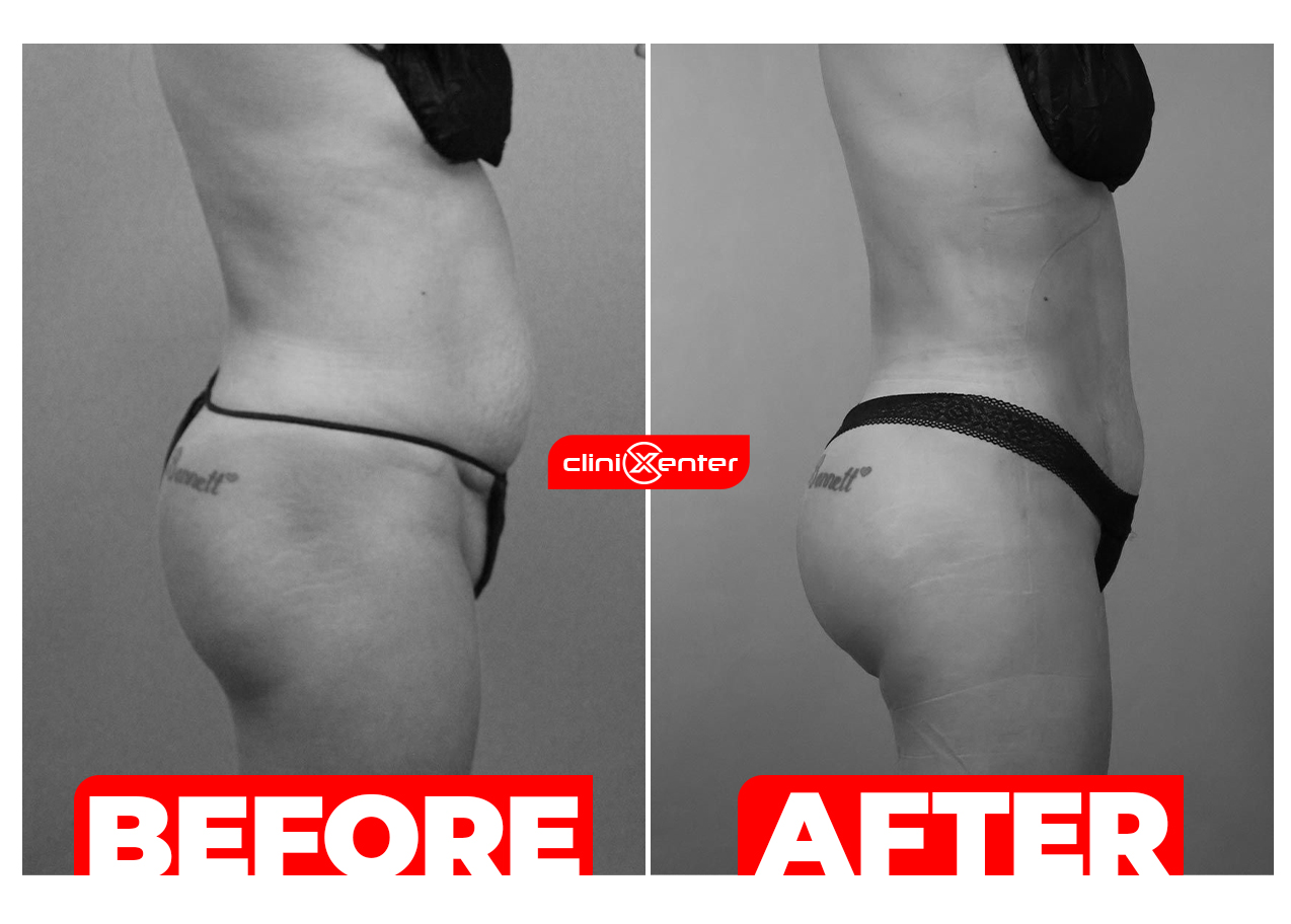 BBL with Tummy Tuck Before and After Cover