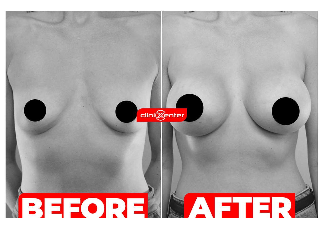 Breast Augmentation Before and After cover