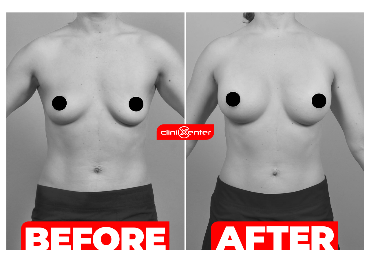 Breast Enlargement Before and After Cover