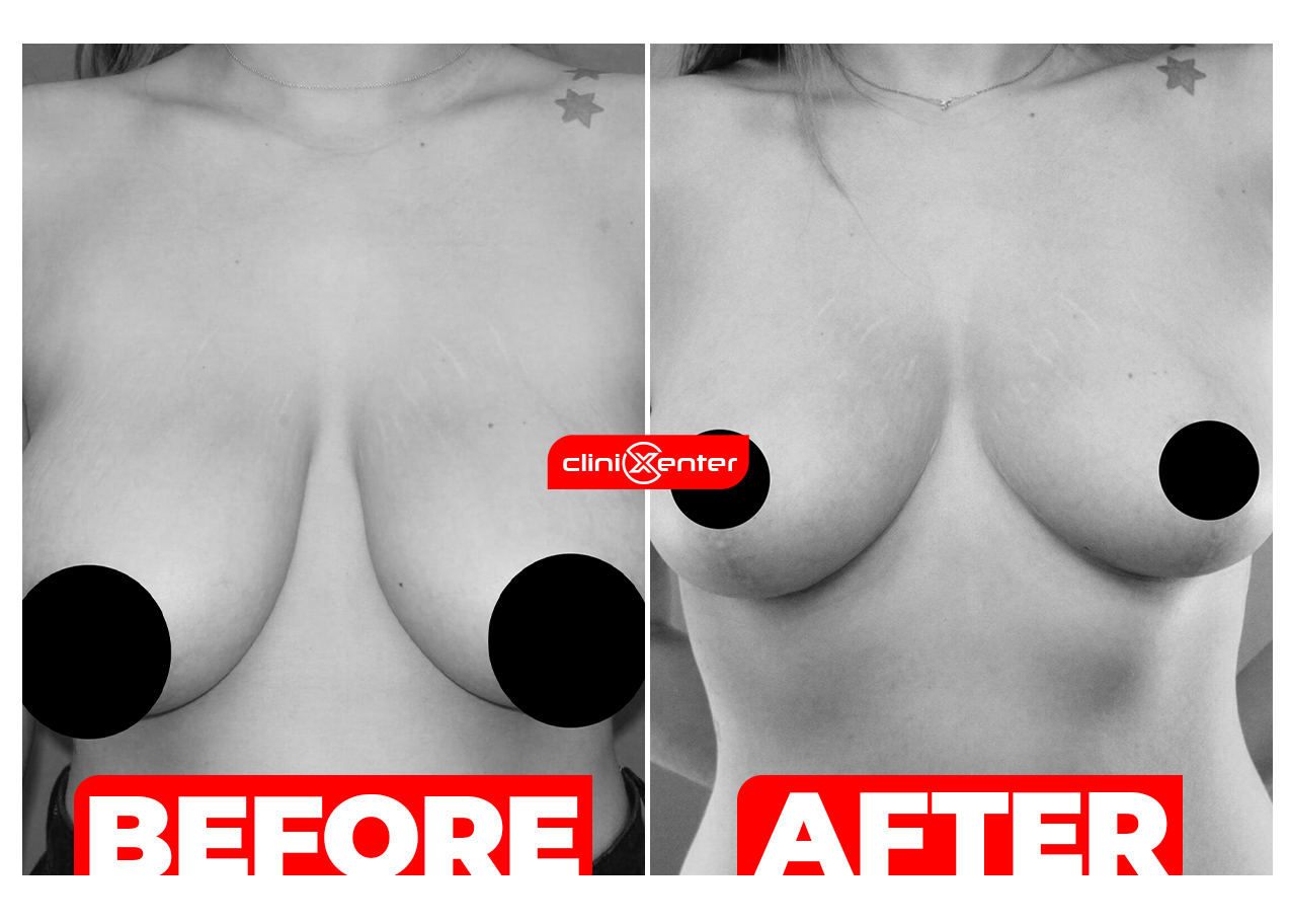 Breast Lift Before and After Cover