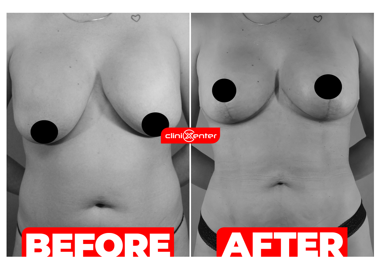 Breast Lift with Liposuction Cover