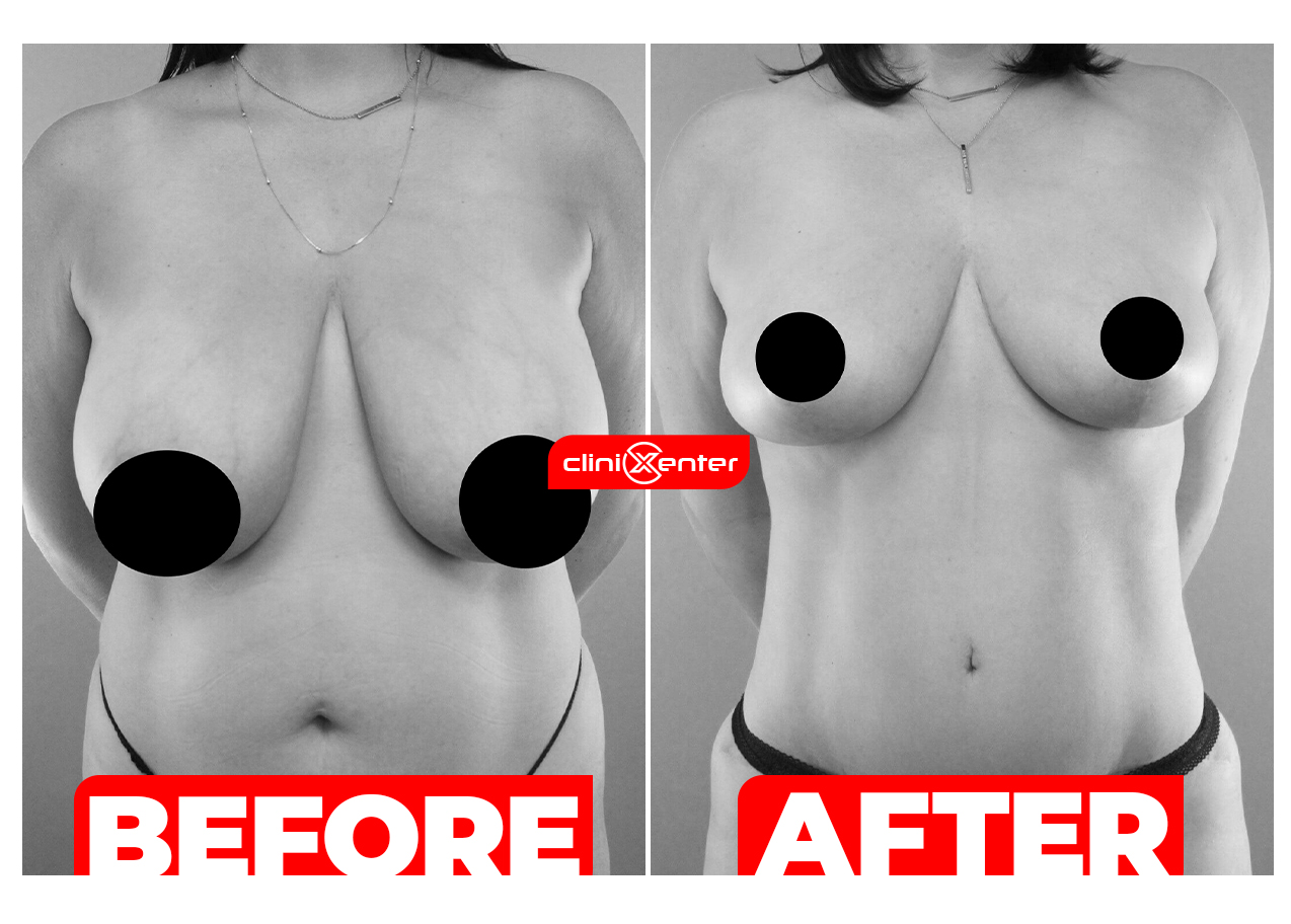 Breast Lift with Reduction Cover