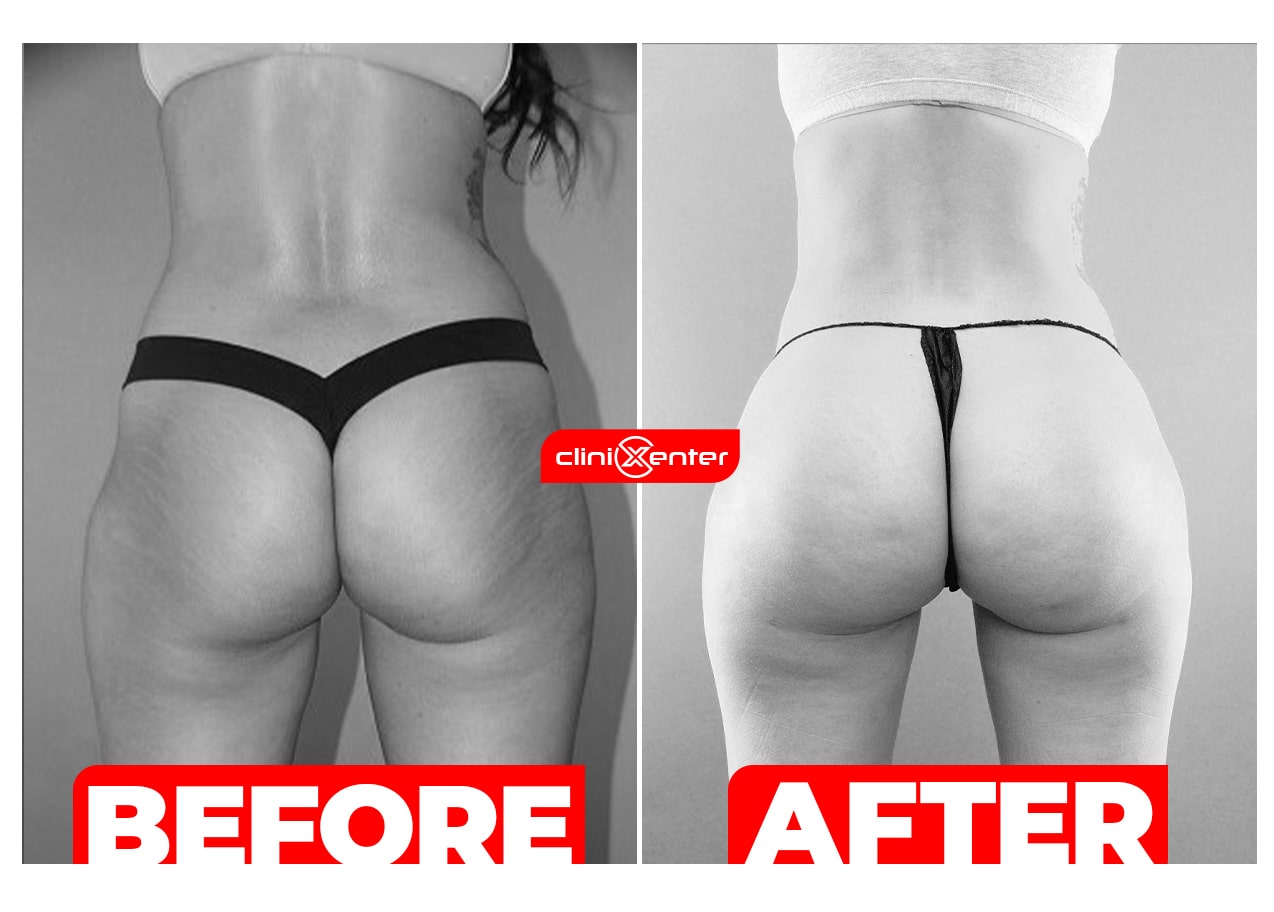 Brezilian Butt Lift Before and After cover min