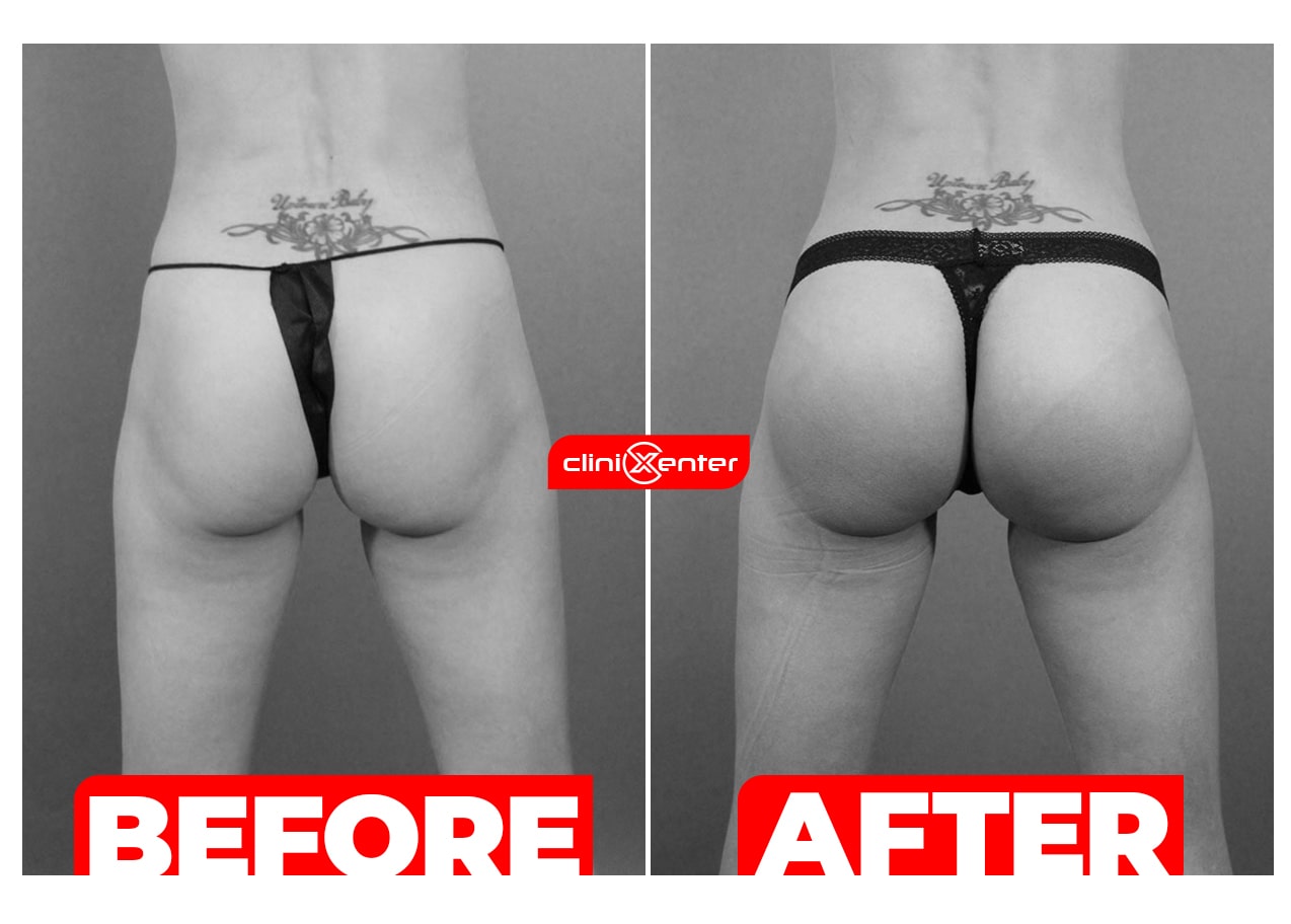 Butt Implants Before and After cover min