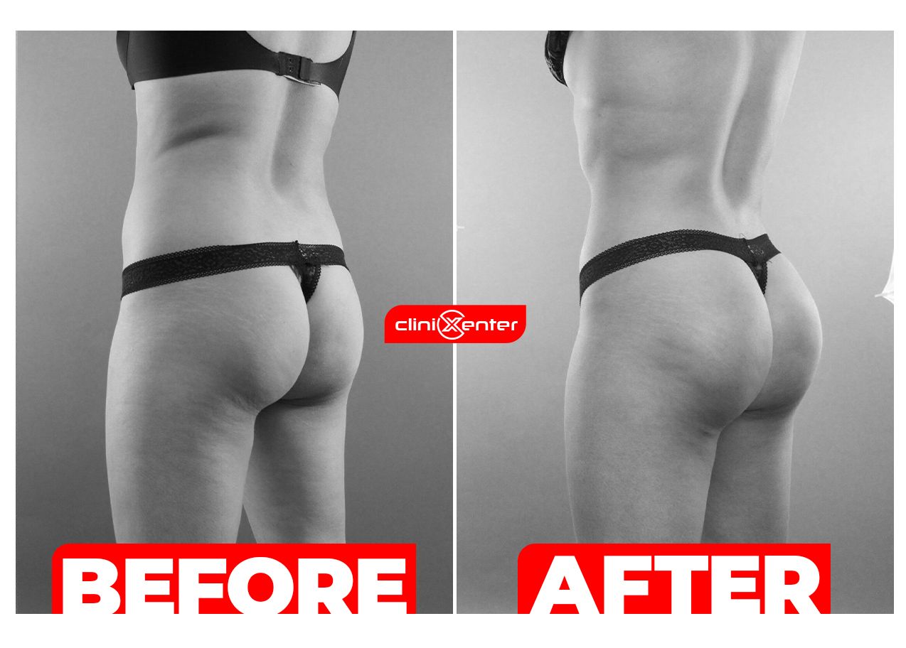 Buttocks Augmentation Before and After Cover