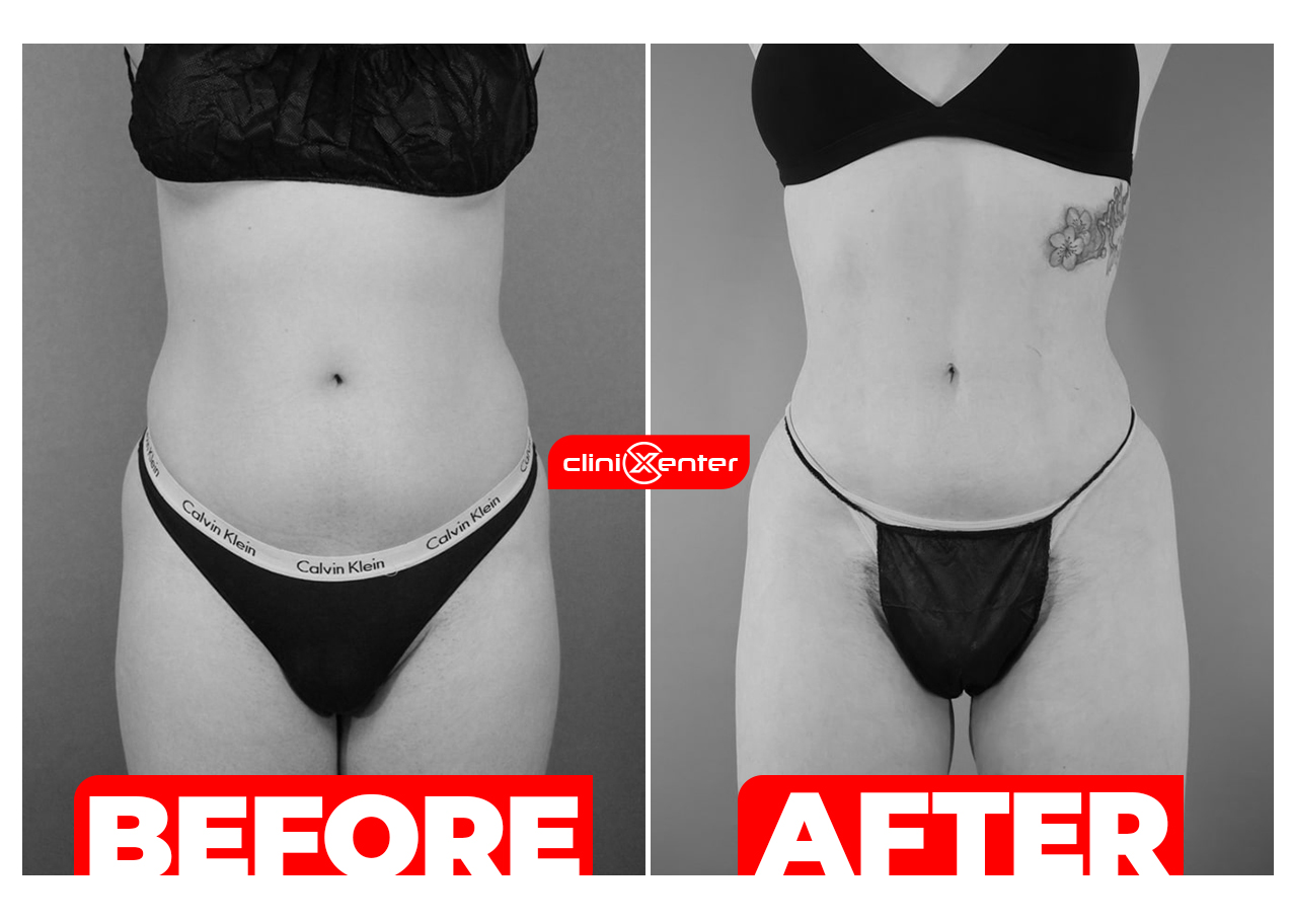 Liposuction Before and After Photos cover
