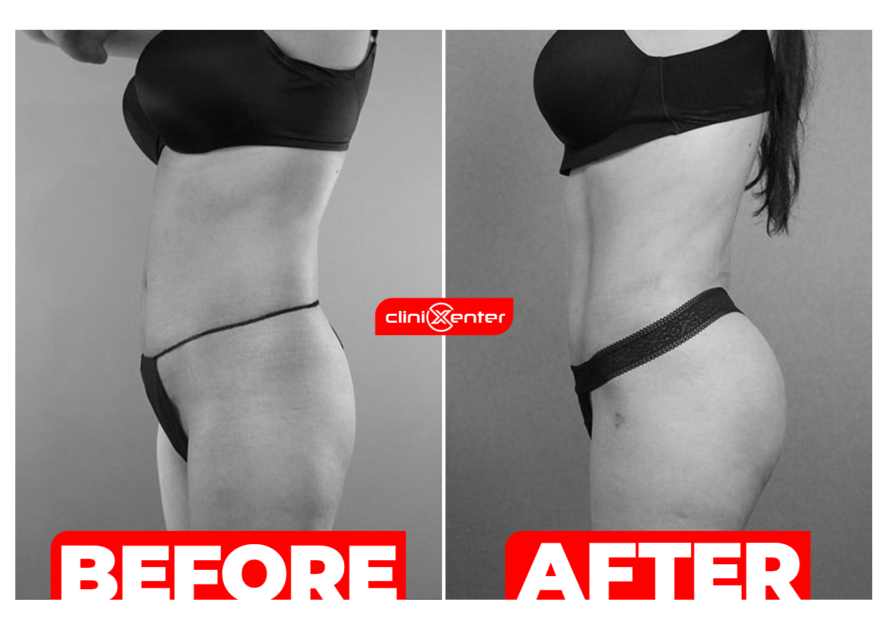 Liposuction Before and After cover