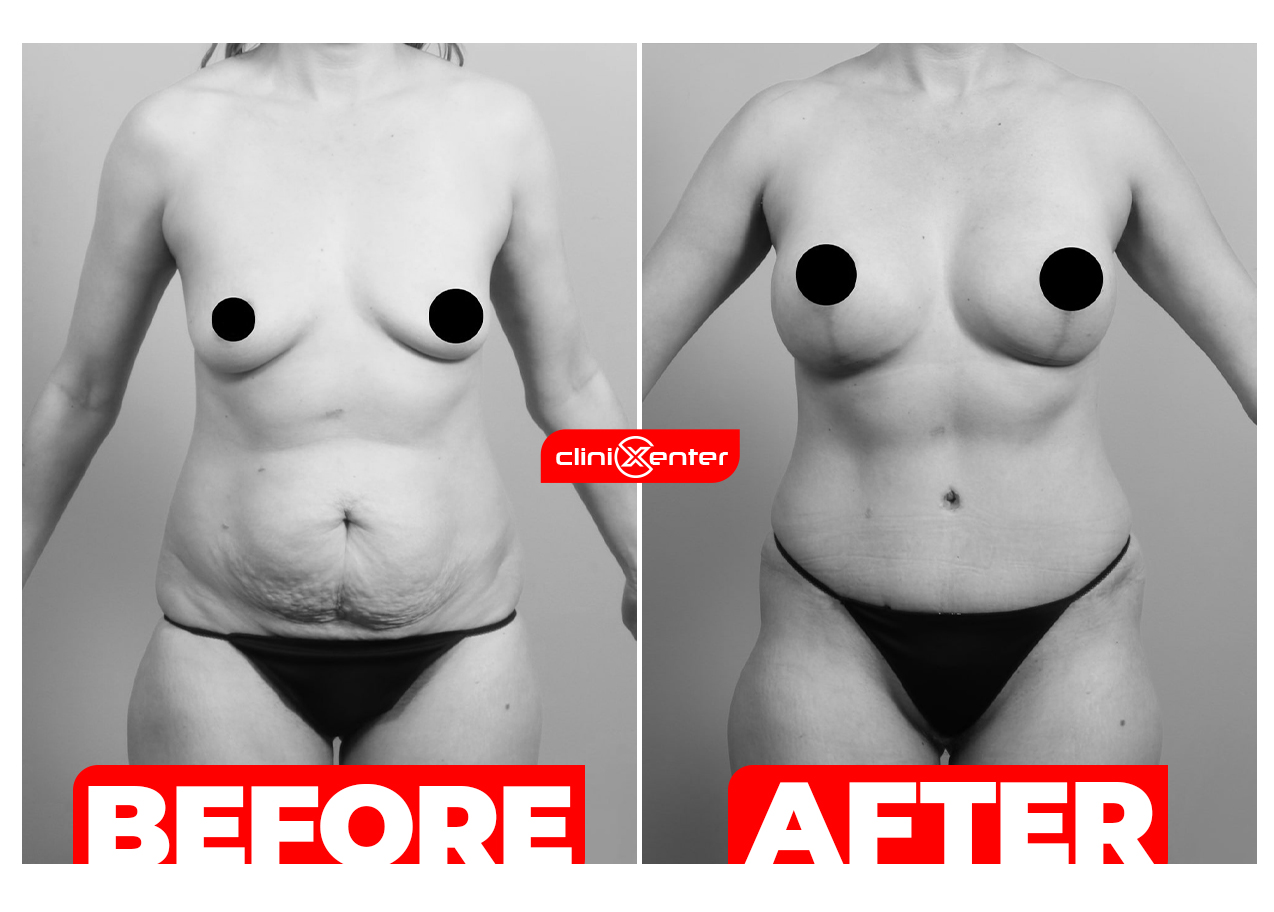 Mommy Makeover with Breast Augmentation cover