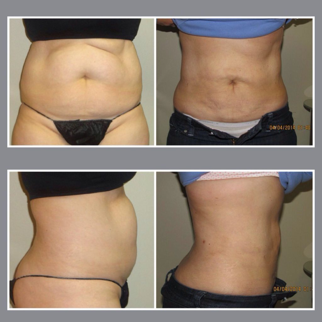 Smart Lipo Before and After 2 Months