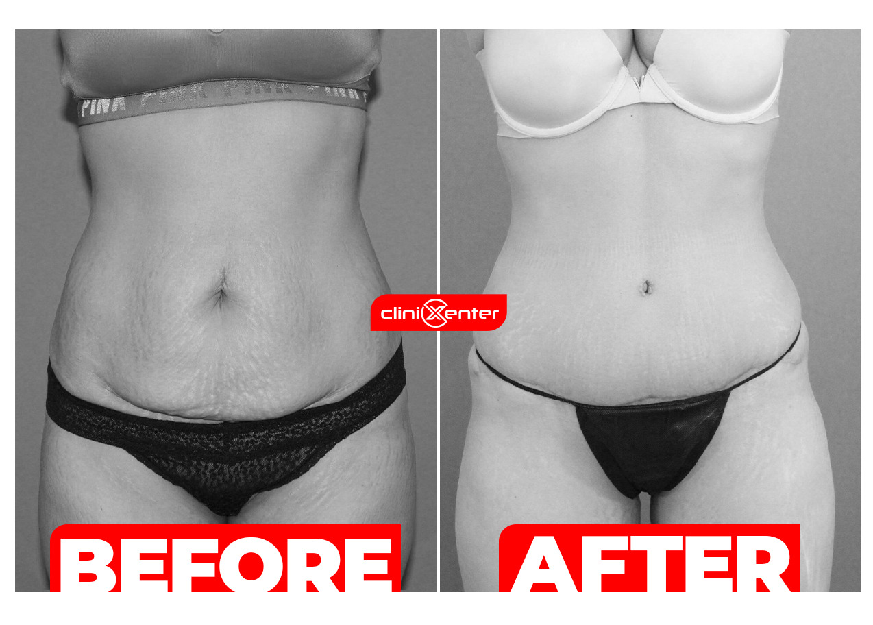 Tummy Tuck Before and After cover