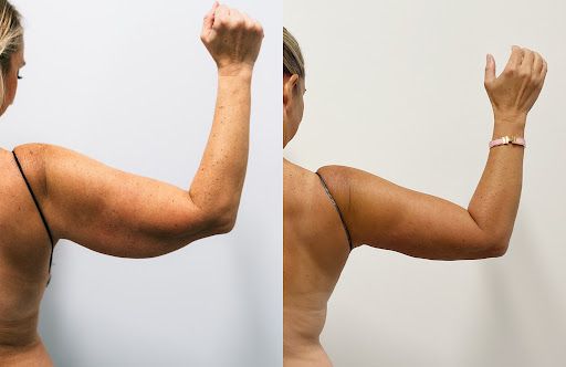 arm liposuction