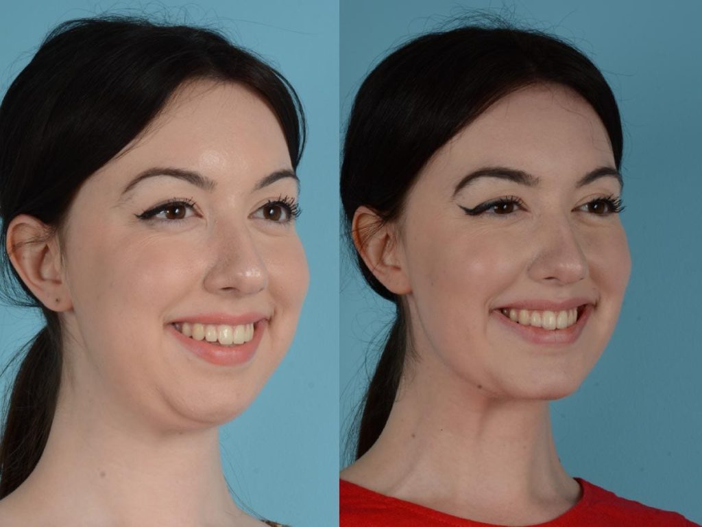 Face Liposuction before and after