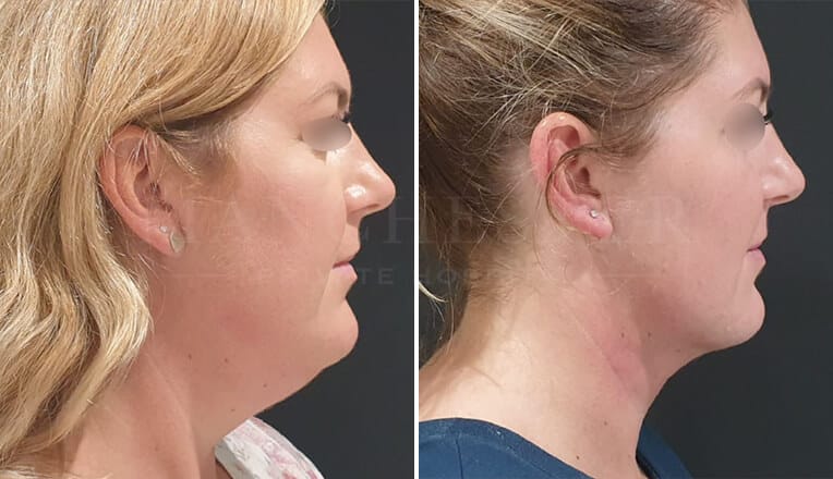Face Liposuction Before and After Real-life Examples