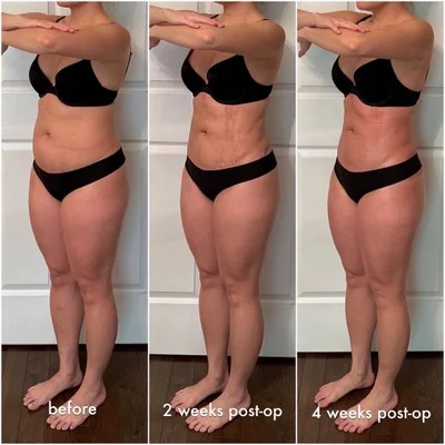 Liposuction week 2 vs week 4